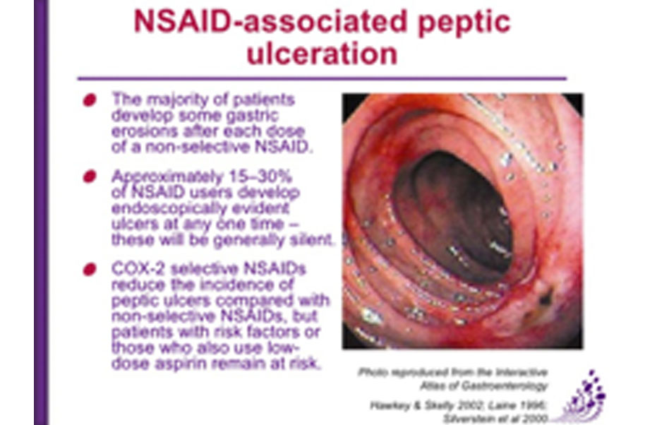 nsaid ulcers treatment