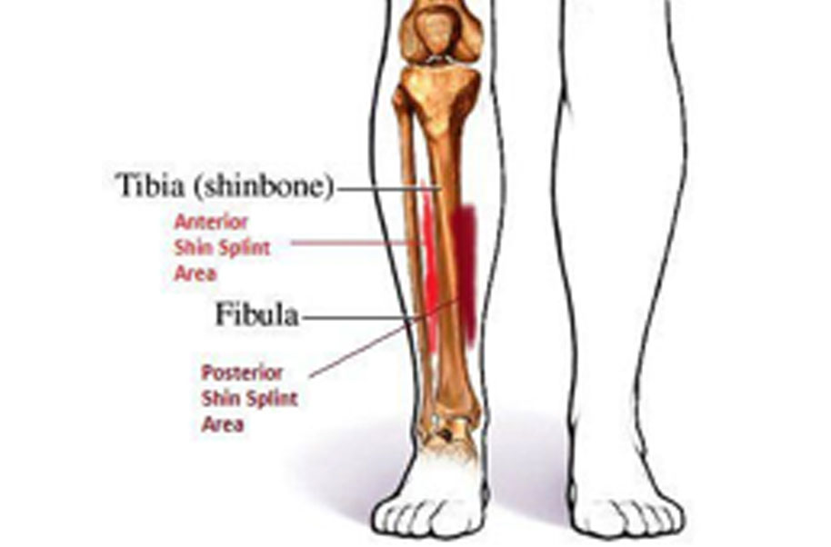 will shin splints cause tib fib fracture
