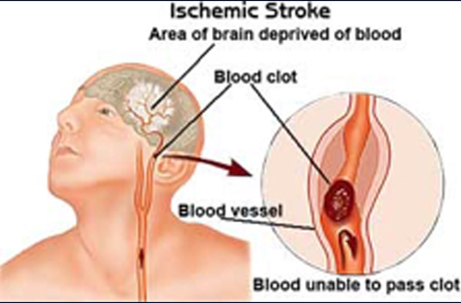 World Thrombosis Day on X: Some strokes are #embolic, blood clots starting  in one place and traveling to the brain. #WorldStrokeDay #strokechat   / X