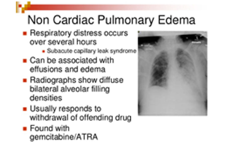 pulmonary edema lung sounds