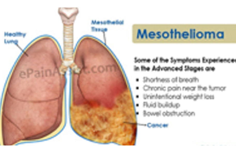 Muscle Weakness & Mesothelioma