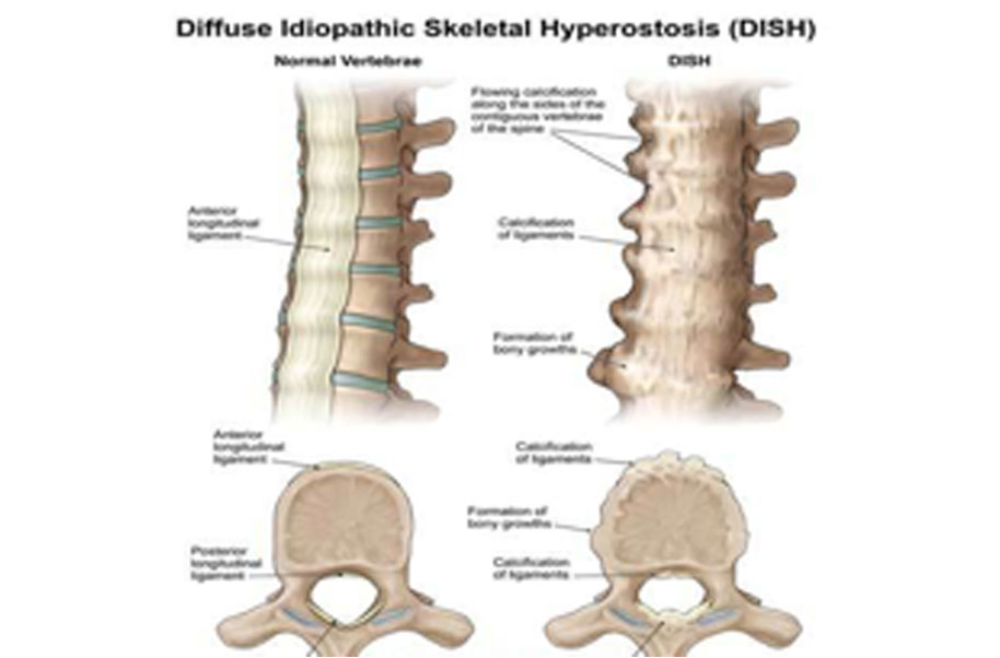 diptic diffuse idiopathic