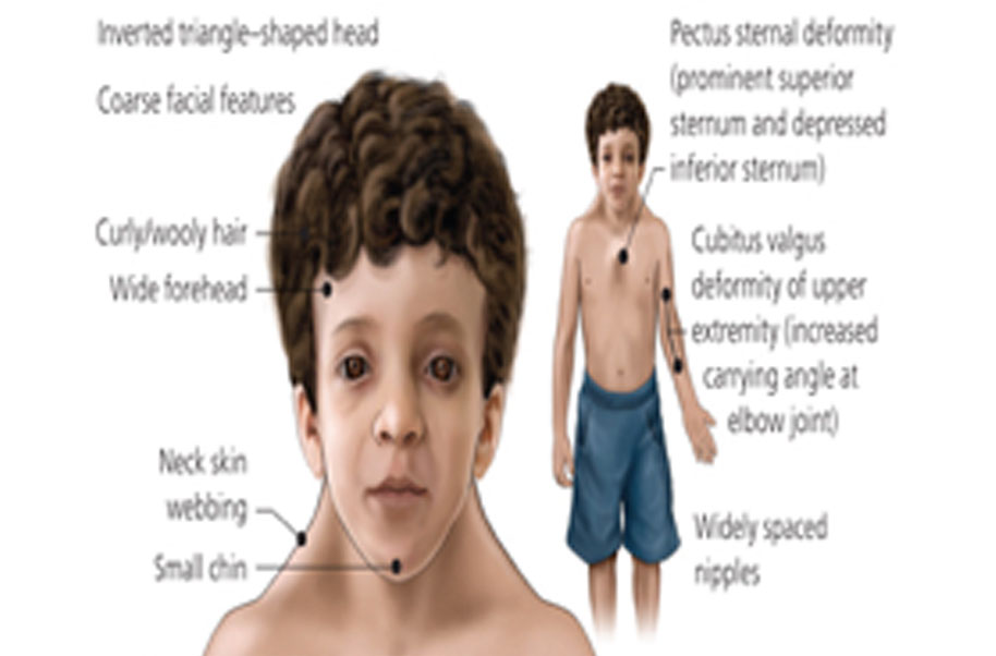 turner syndrome pictures children