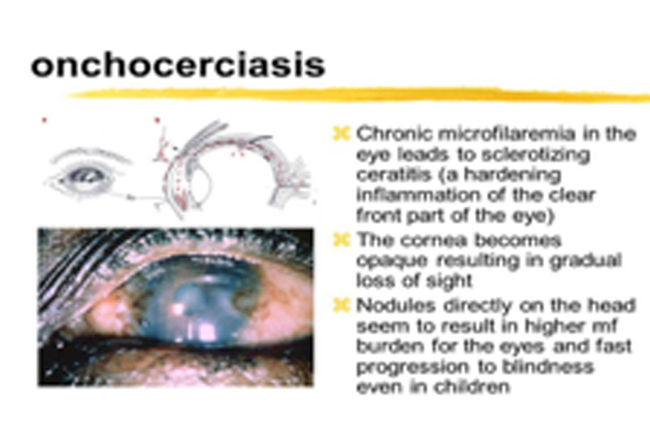 onchocerca volvulus eye