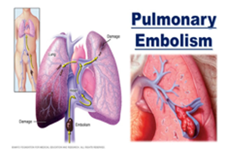 Symptoms Of Pulmonary Embolism My Xxx Hot Girl