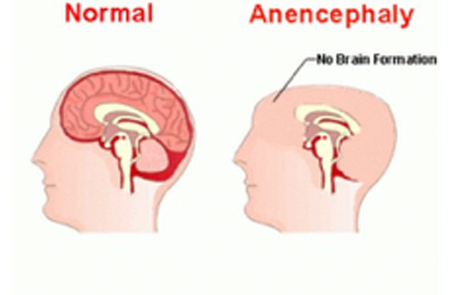 anencephaly diagram